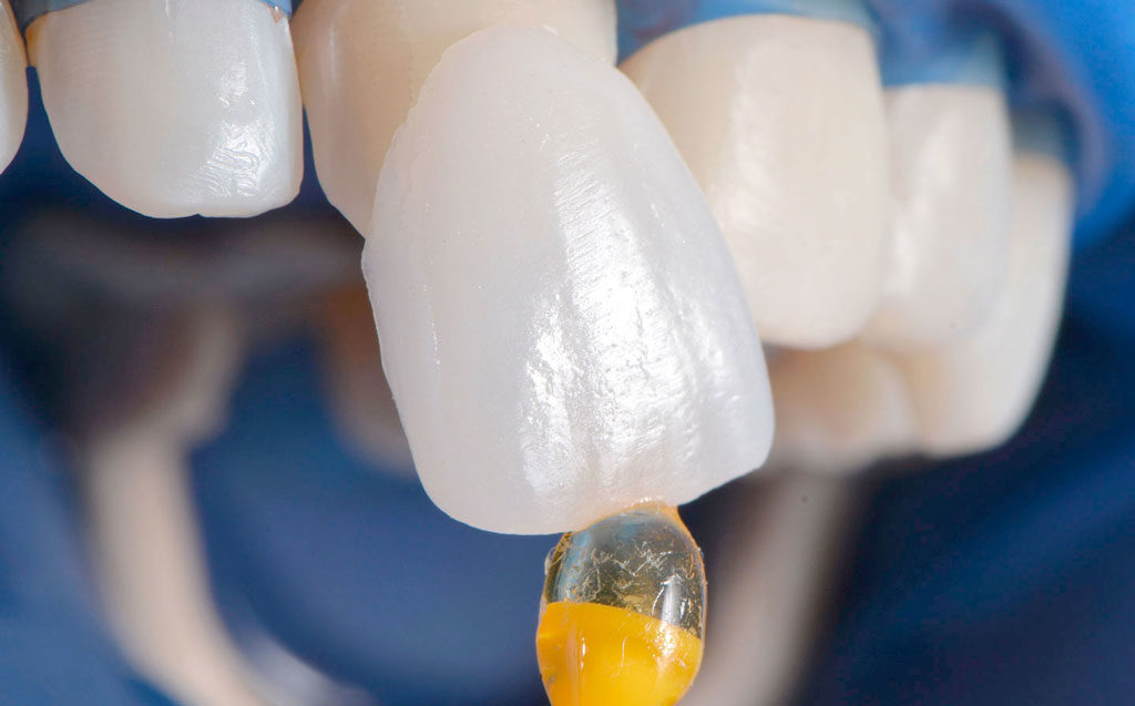 Дефекты на зубах можно закрыть винирами